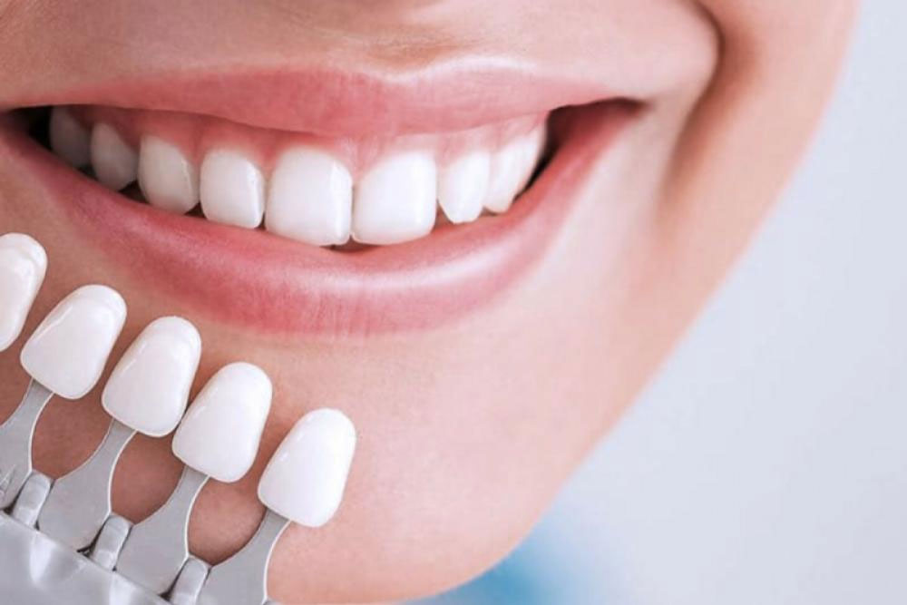 Что такое виниры для зубов: современное решение для идеальной улыбки