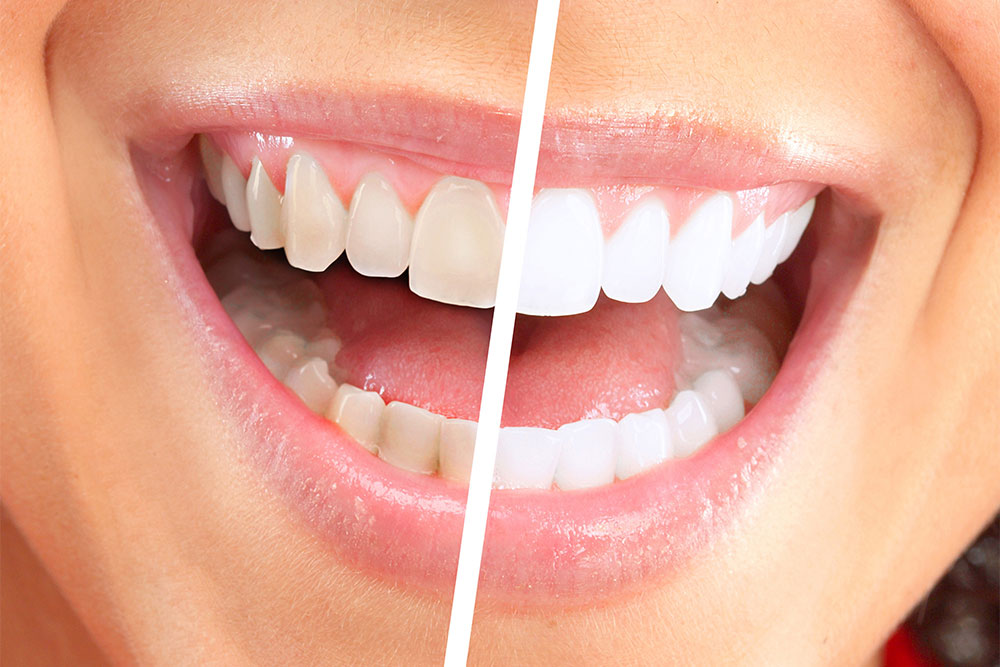 Як відбілити зуби в домашніх умовах: покращуємо свою усмішку